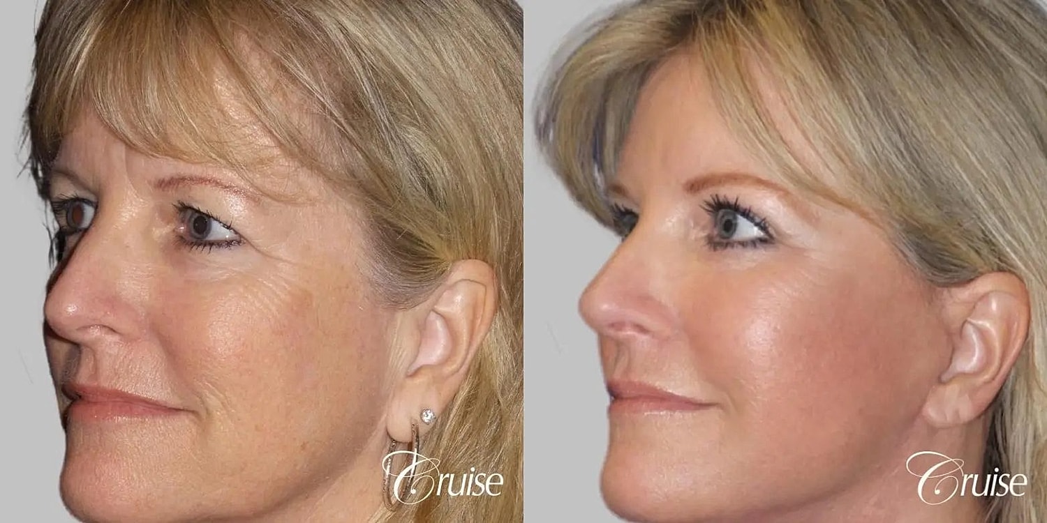 Facial Fat Transfer Before & After