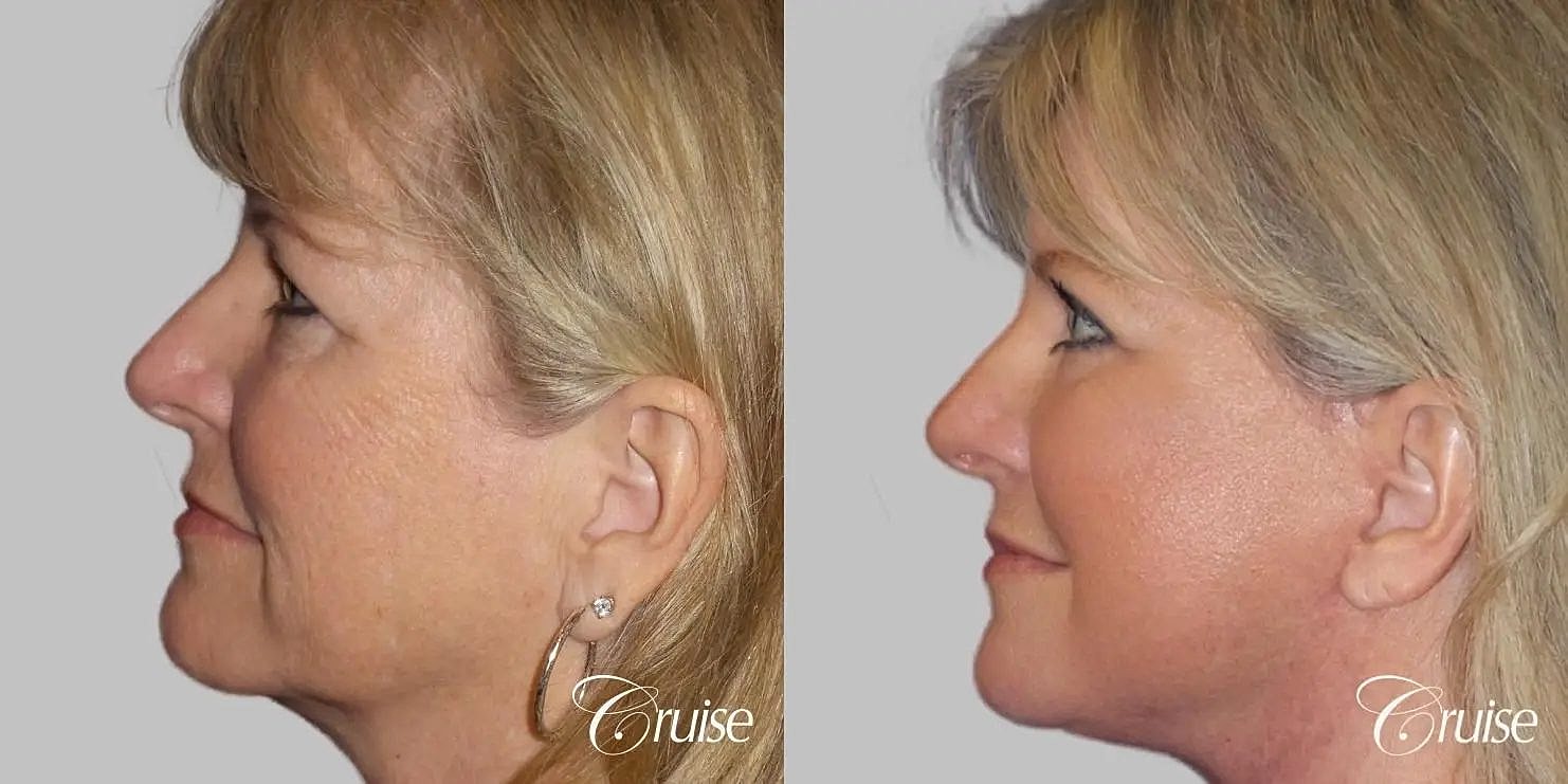 Facial Fat Transfer Before & After