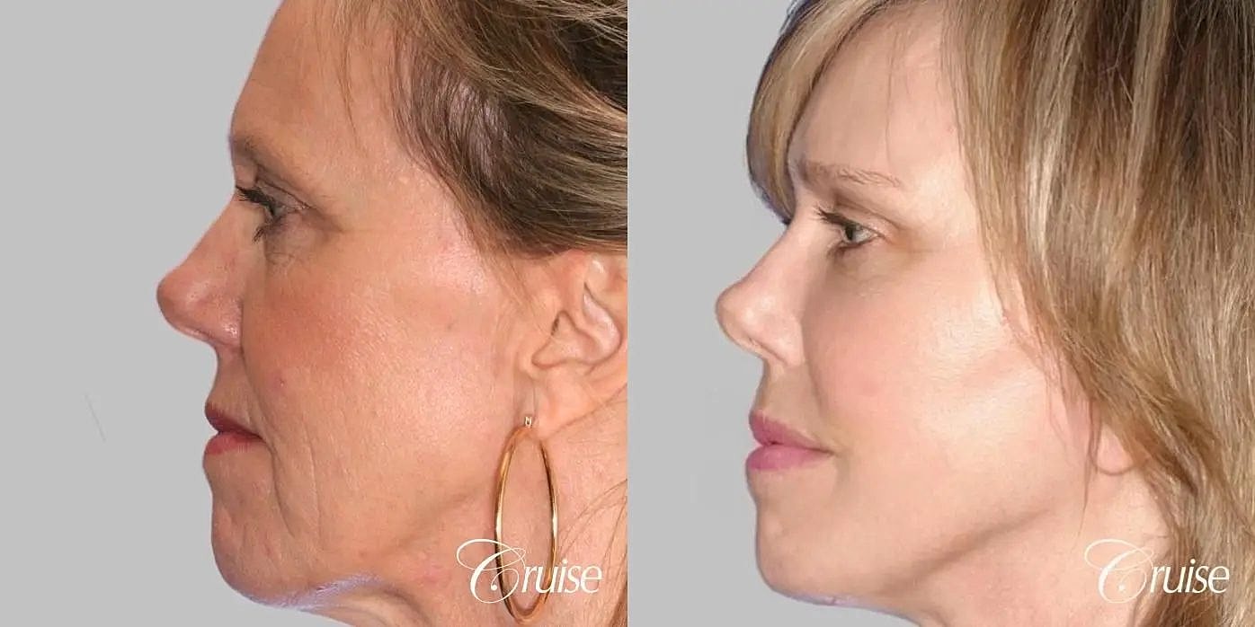 Facial Fat Transfer Before & After