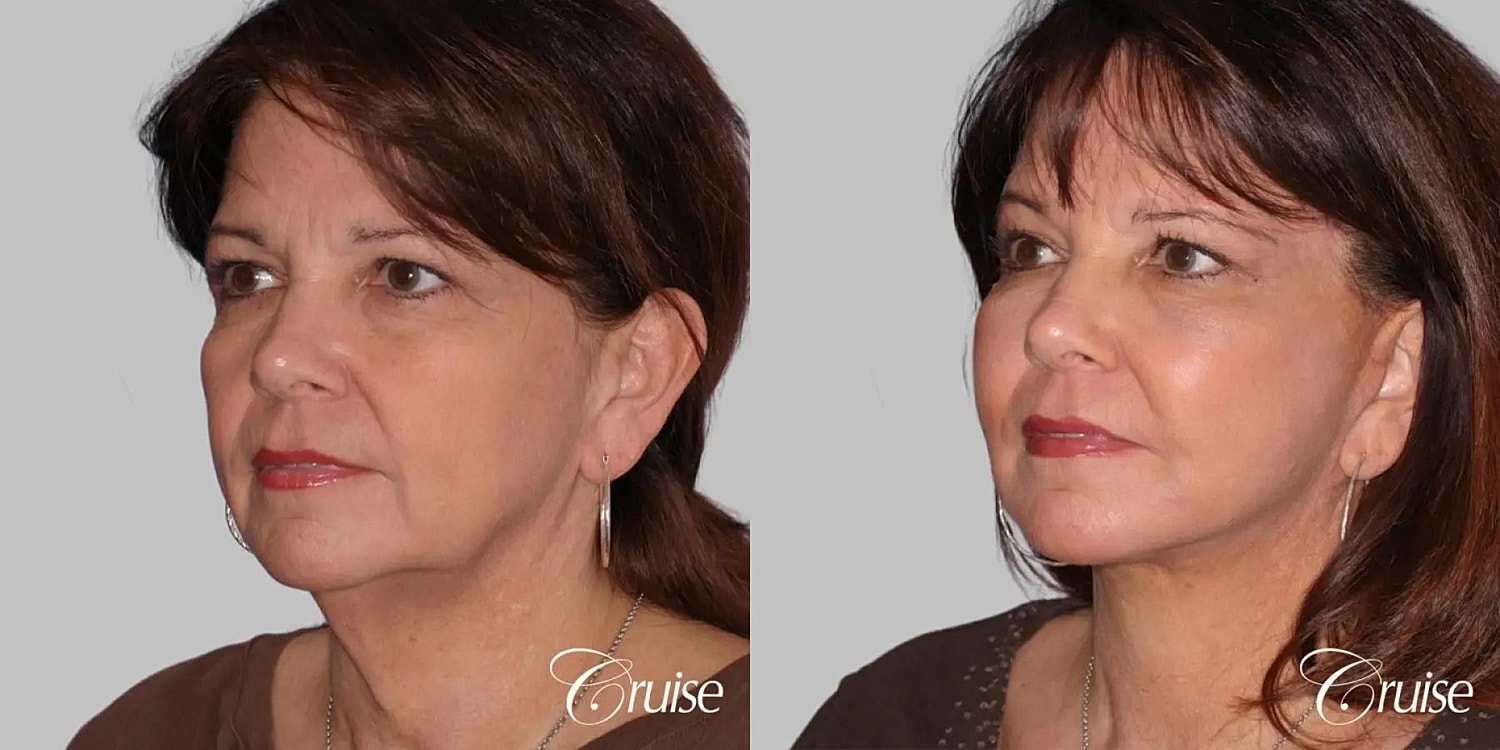 Facial Fat Transfer Before & After