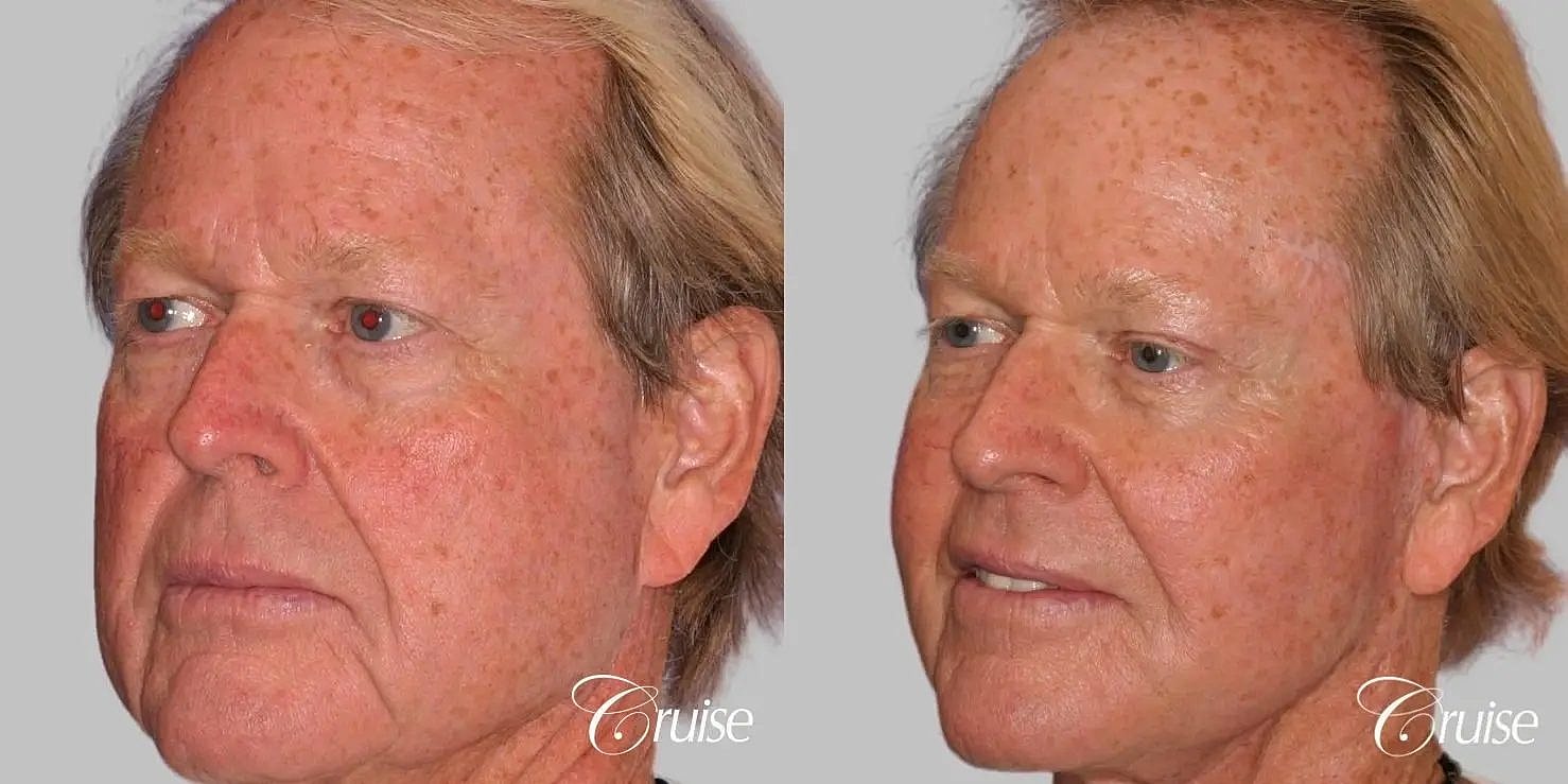Facial Fat Transfer Before & After