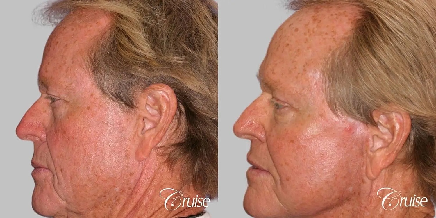 Facial Fat Transfer Before & After