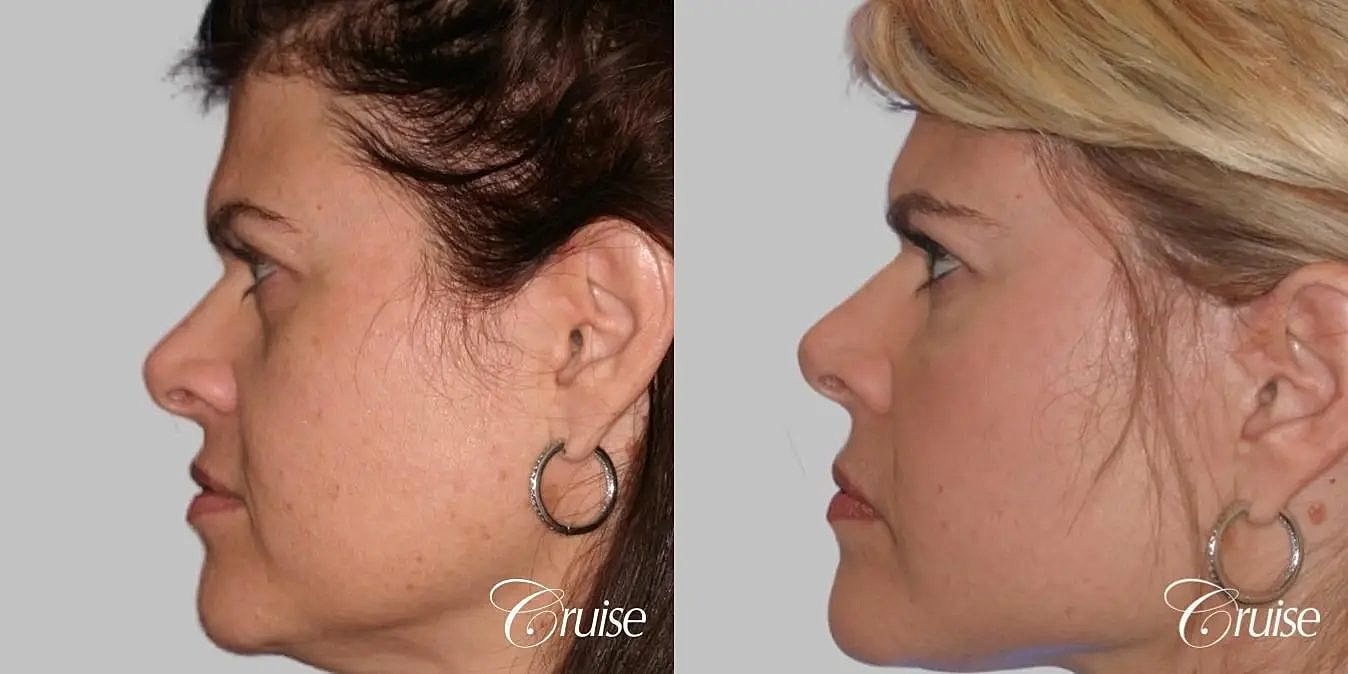 Facial Fat Transfer Before & After
