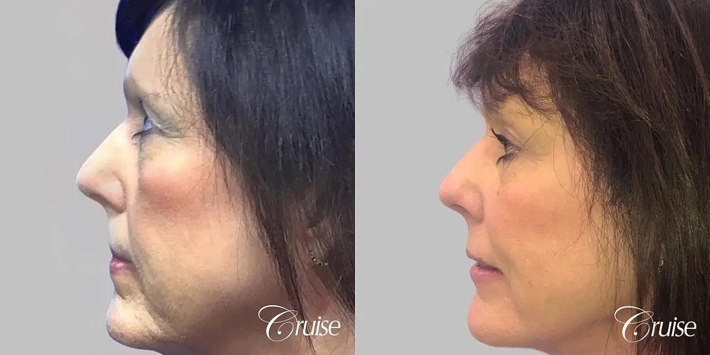 Facial Fat Transfer Before & After