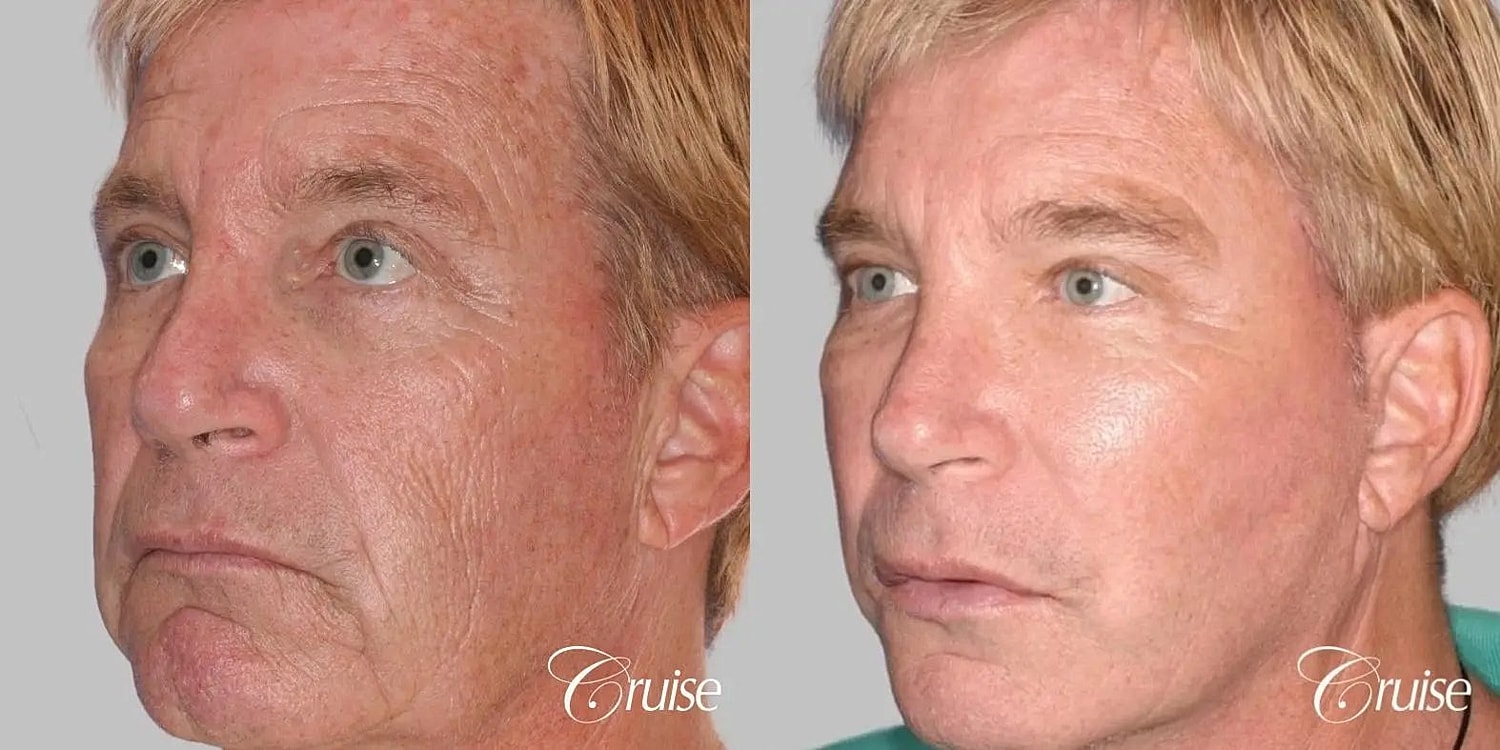 Facial Fat Transfer Before & After