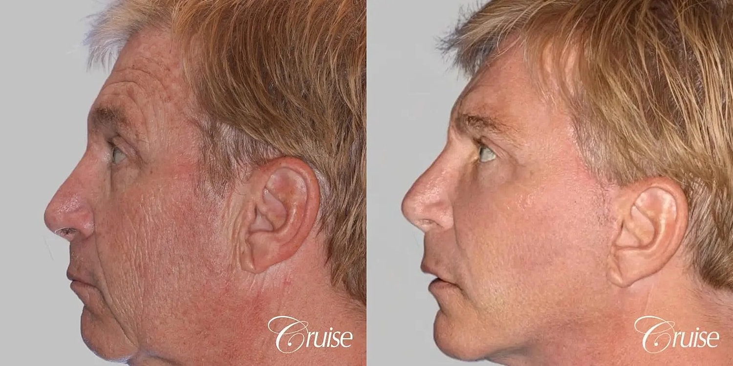 Facial Fat Transfer Before & After