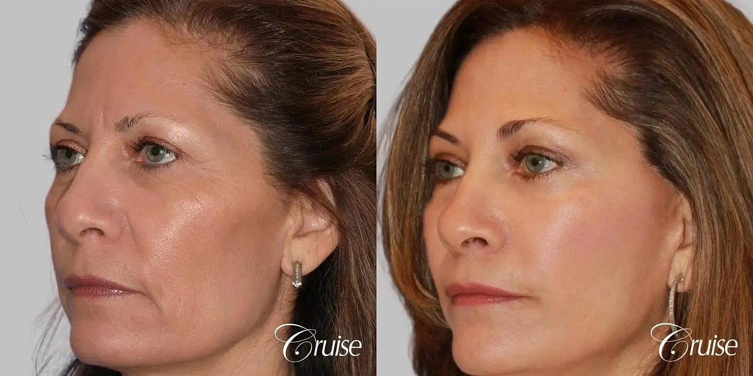 Facial Fat Transfer Before & After