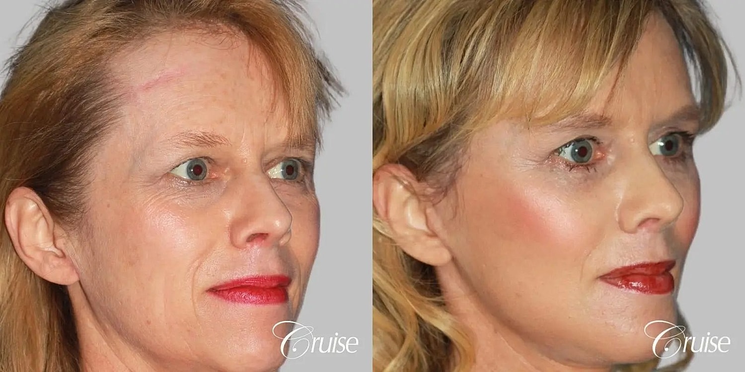 Facial Fat Transfer Before & After