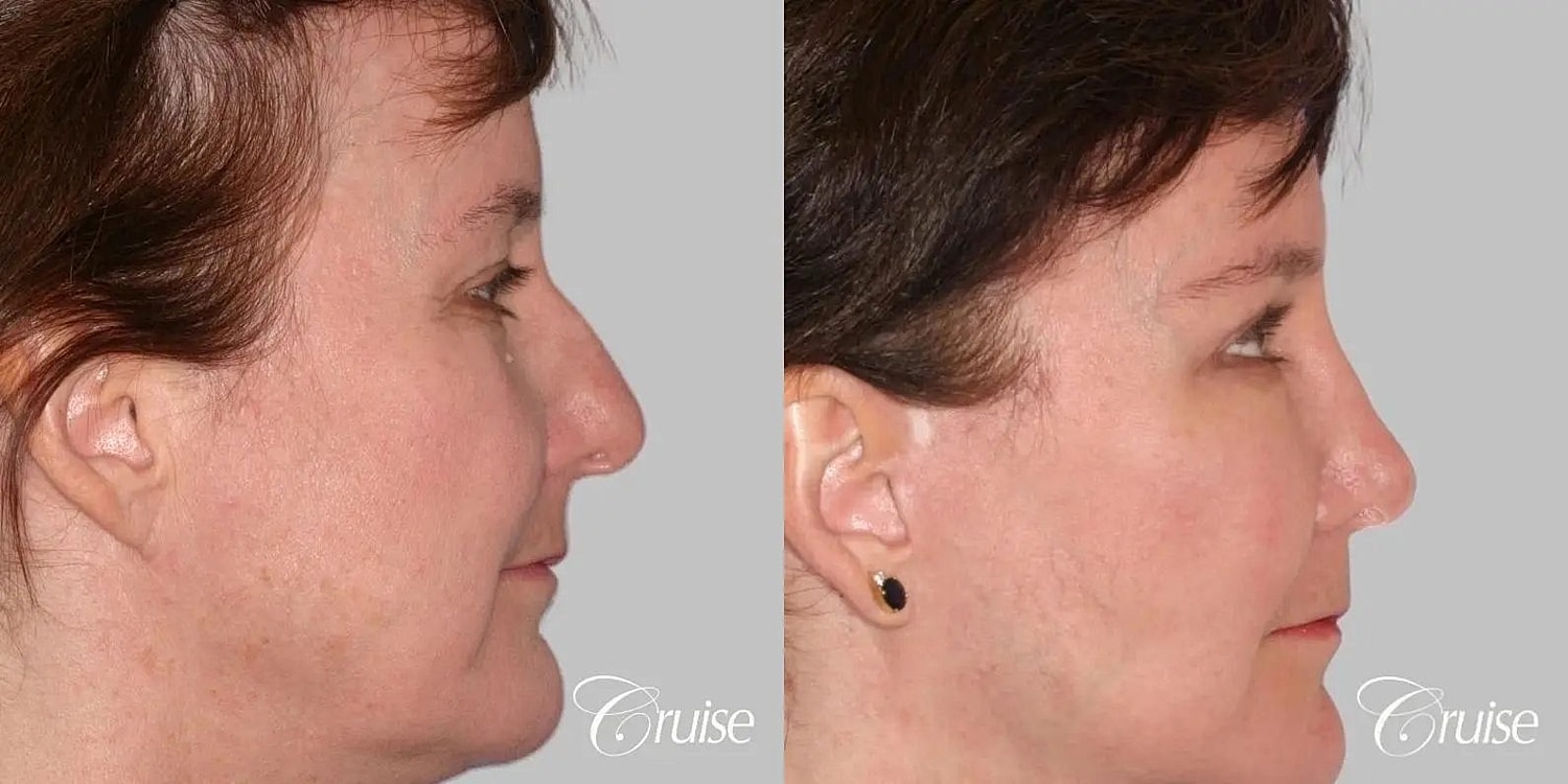 Facial Fat Transfer Before & After