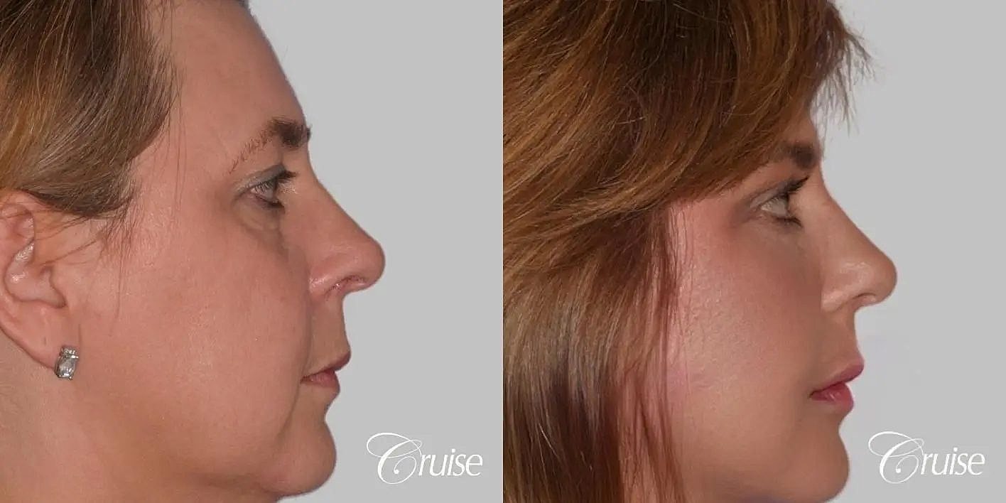 Facial Fat Transfer Before & After