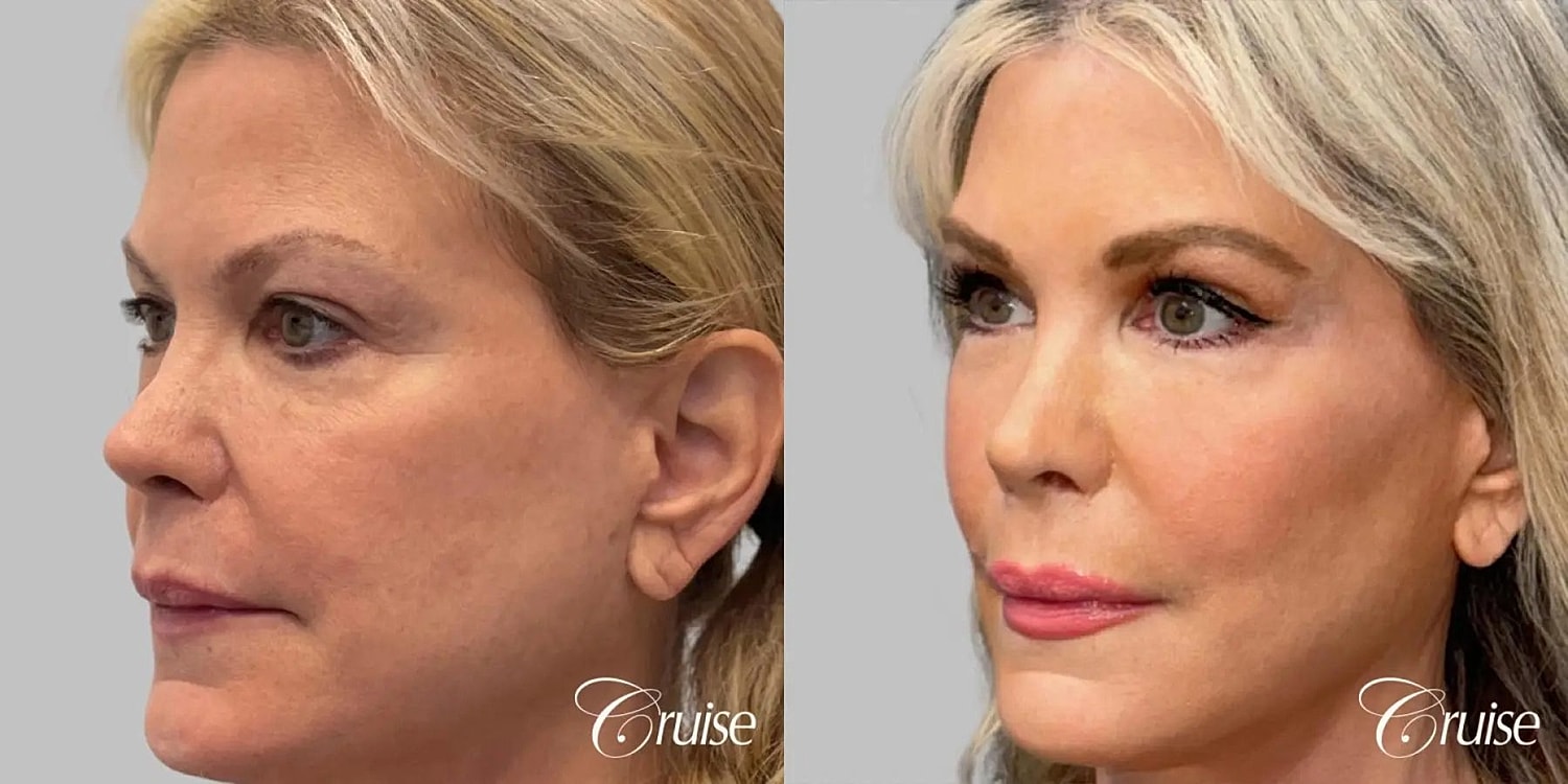 Facial Fat Transfer Before & After