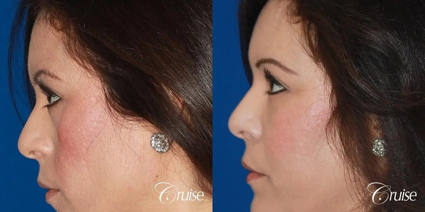 Facial Fat Transfer Before & After