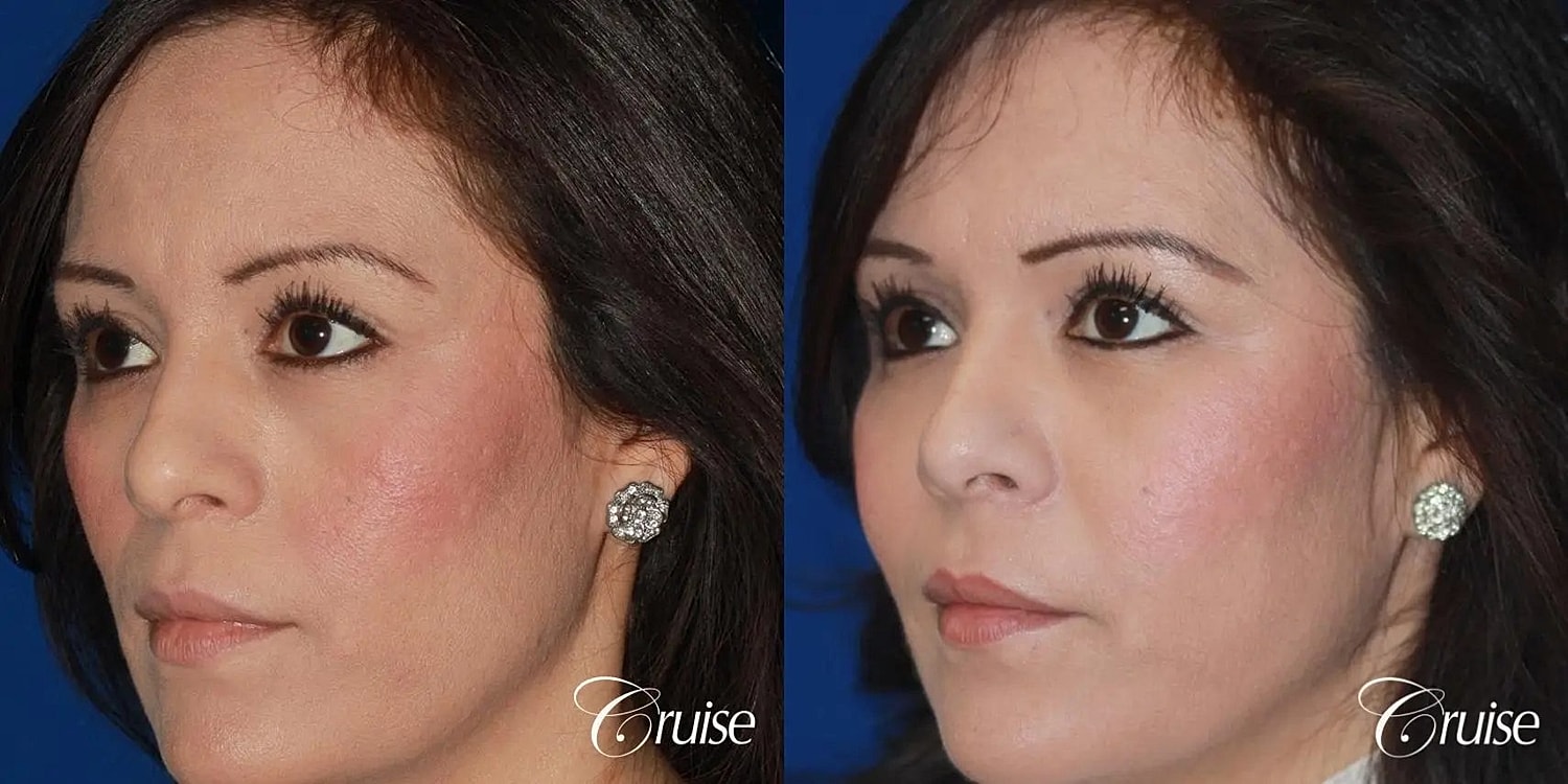 Facial Fat Transfer Before & After