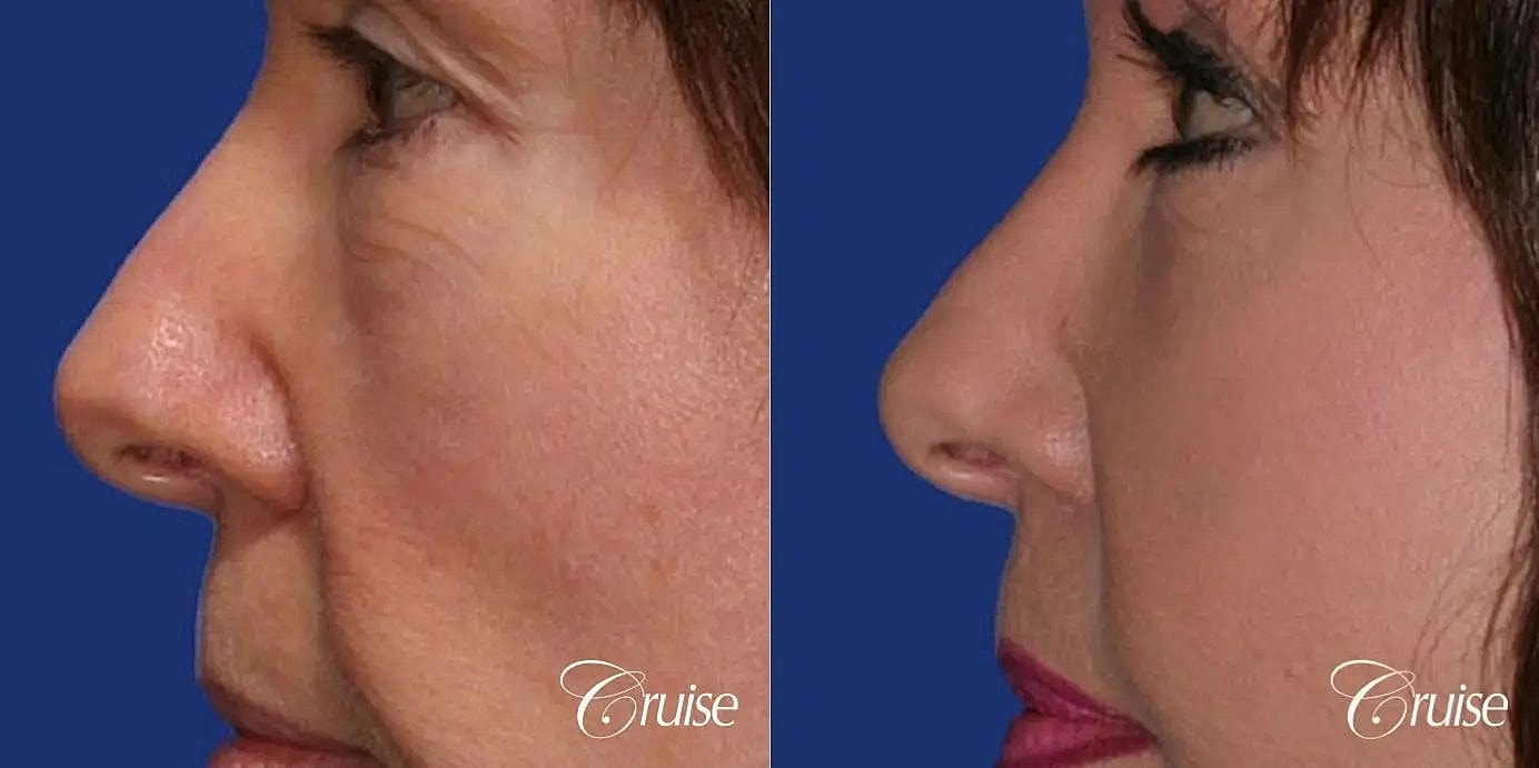 Facial Fat Transfer Before & After