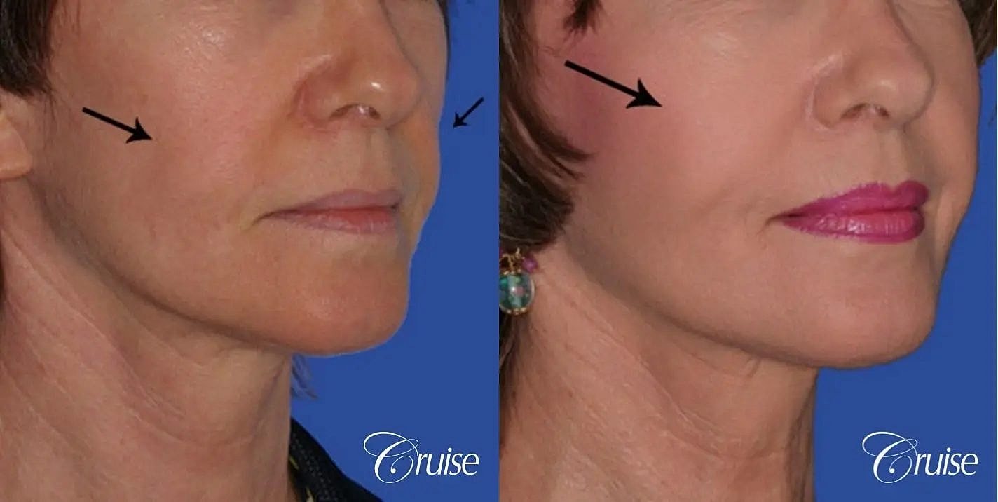 Facial Fat Transfer Before & After