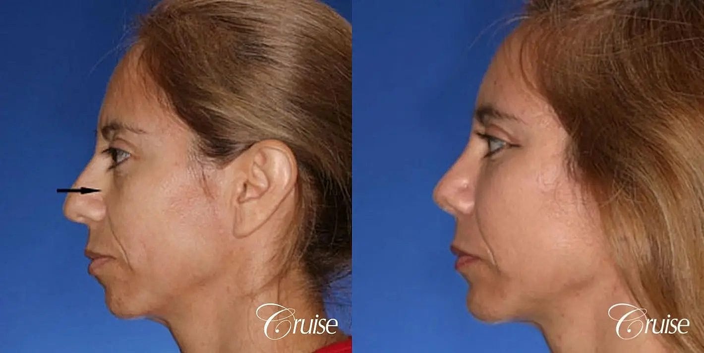 Facial Fat Transfer Before & After