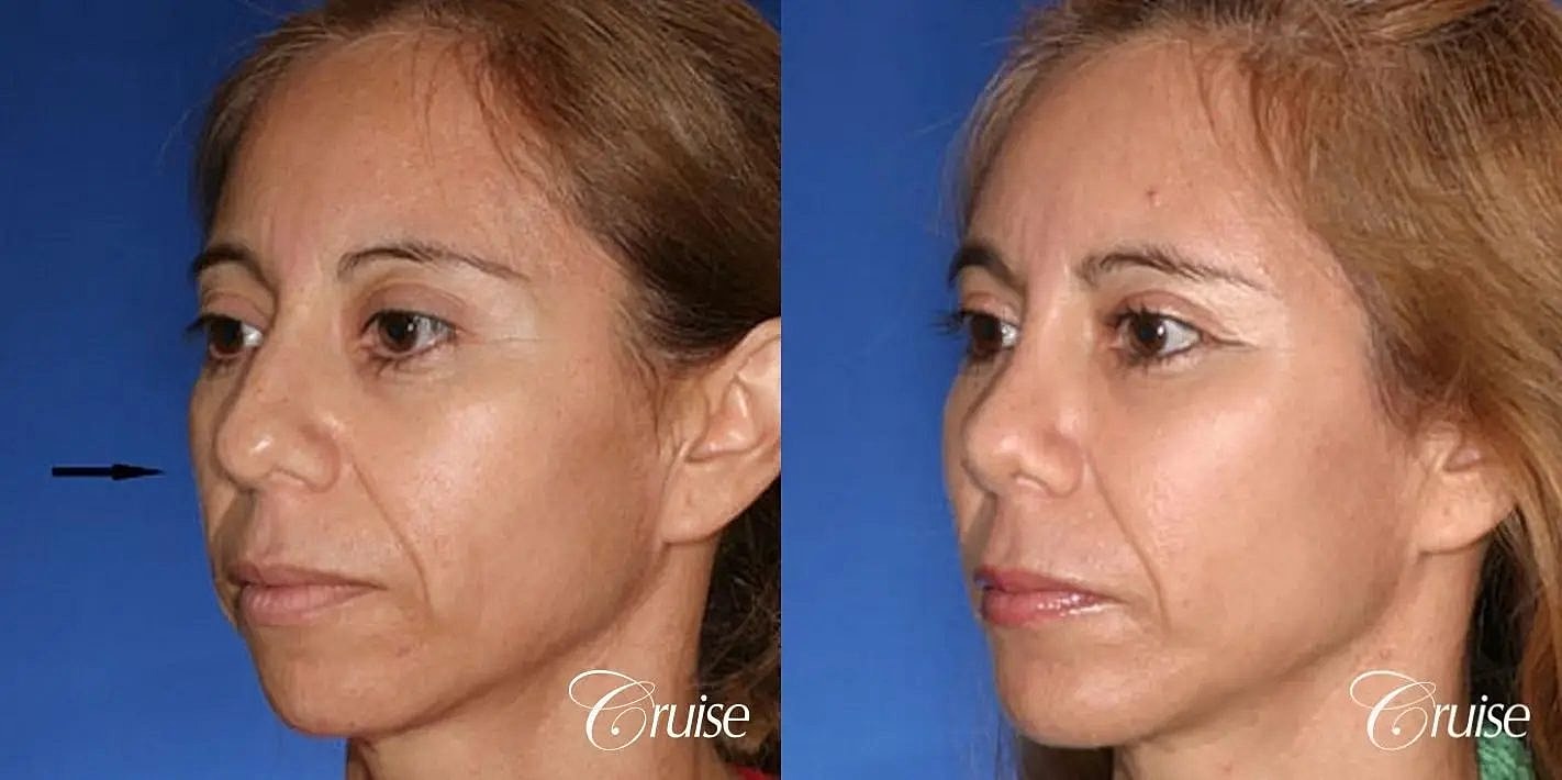 Facial Fat Transfer Before & After