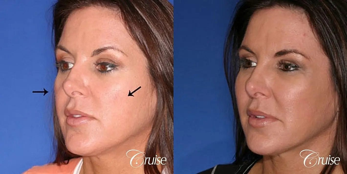 Facial Fat Transfer Before & After