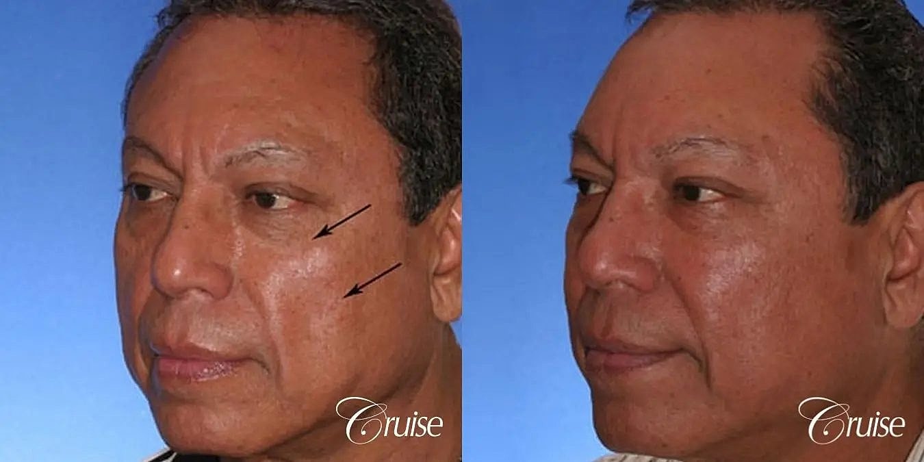 Facial Fat Transfer Before & After