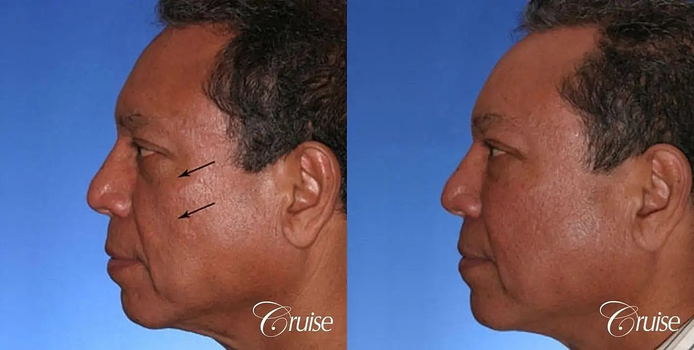 Facial Fat Transfer Before & After