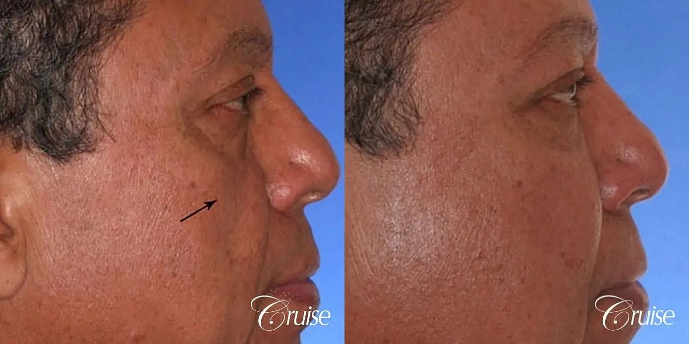 Facial Fat Transfer Before & After