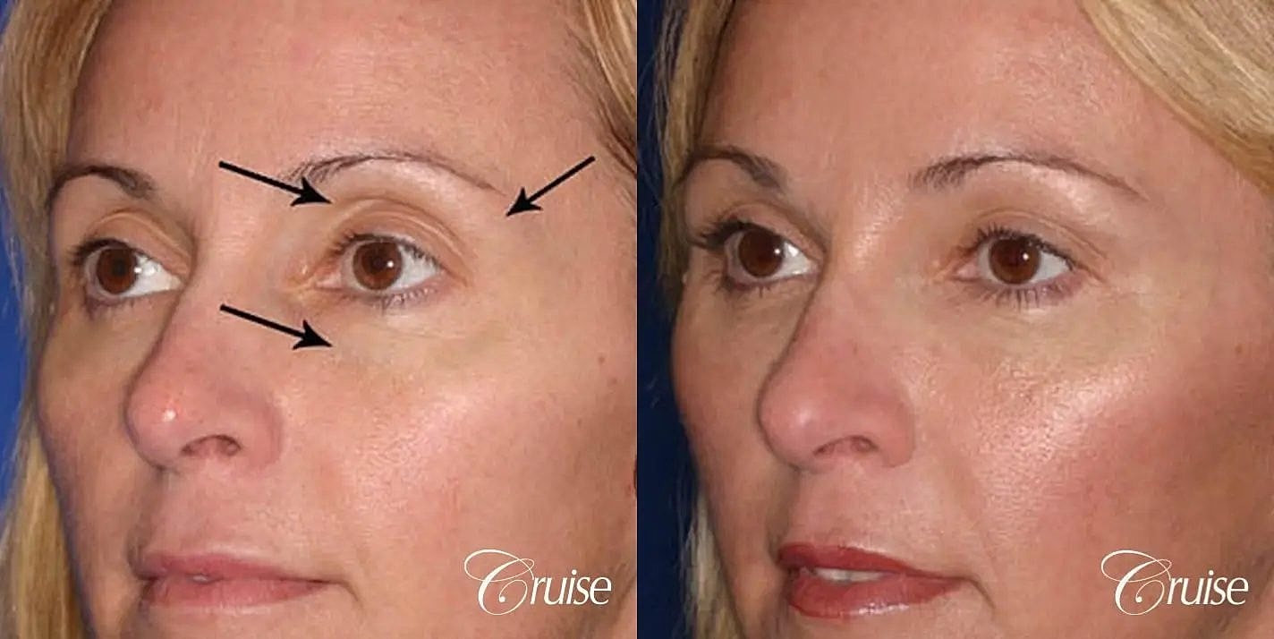 Facial Fat Transfer Before & After