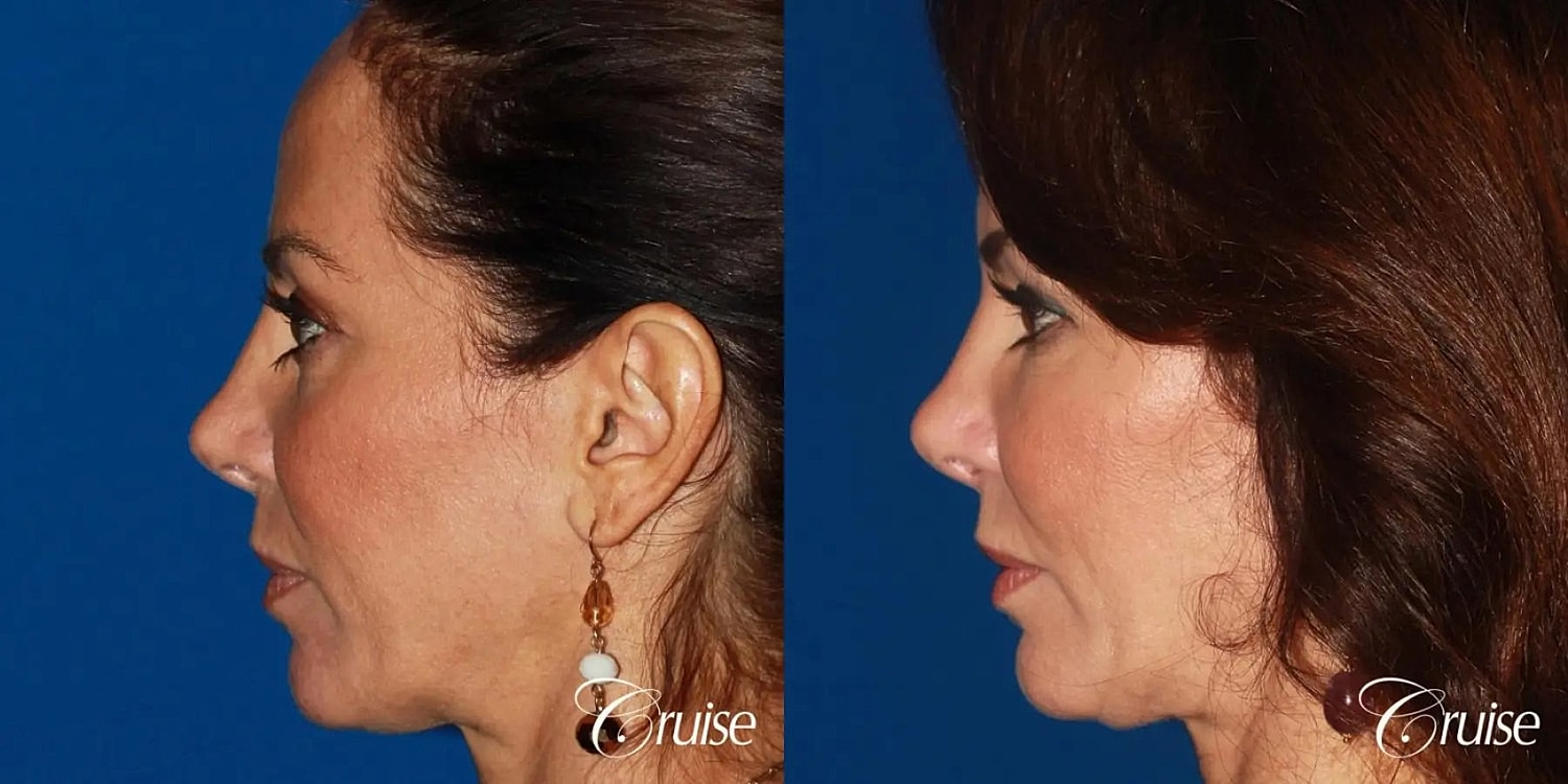 Facial Fat Transfer Before & After