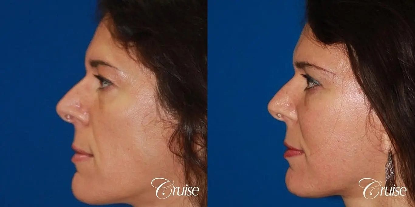 Facial Fat Transfer Before & After