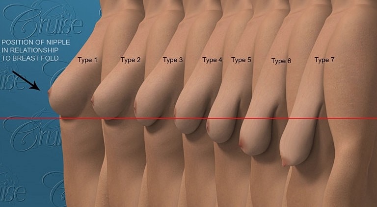 Diagram of nipple positions in breast anatomy.