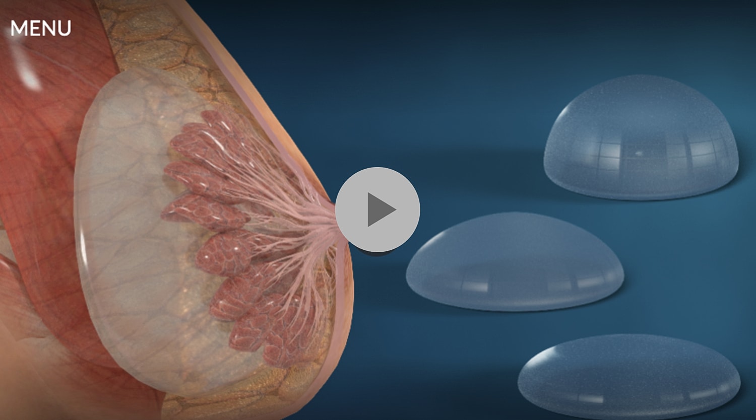Breast anatomy with silicone implant comparison.