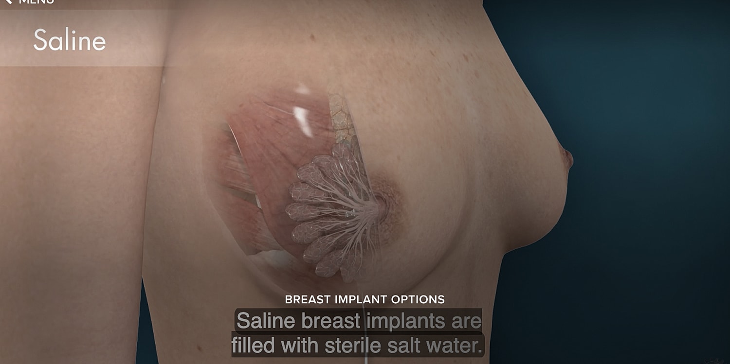 Saline breast implant anatomy and description.