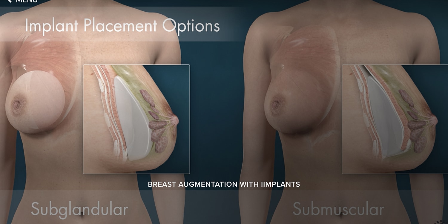 Breast augmentation implant placement options explained.