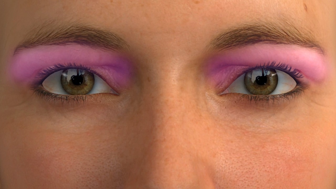 Illustration of breast tissue and possible cancer cells.